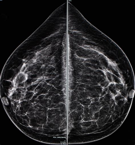 the villages breast cancer mammogram|Advanced Imaging Center at the Villages Breast Mammogram .
